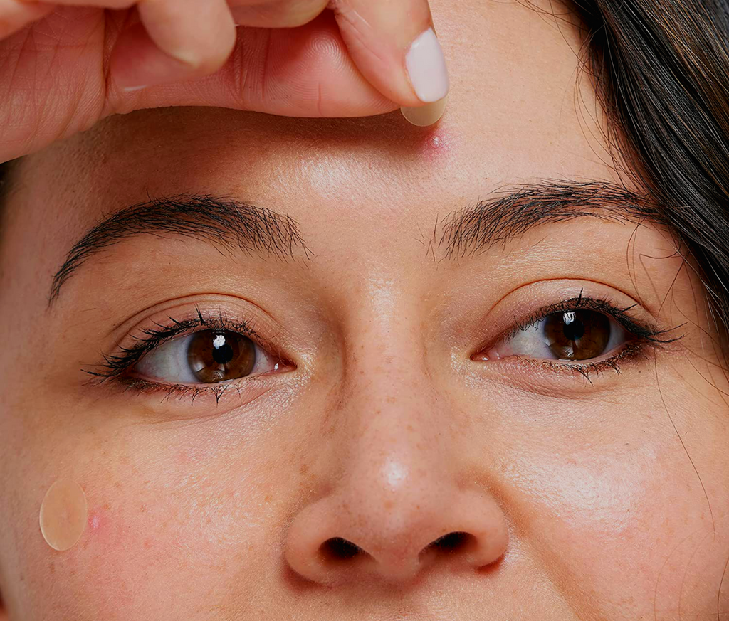 What is a blind pimple and what is the best way to treat one?