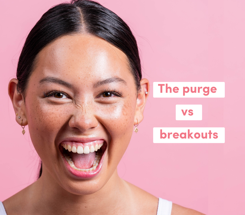 Is it normal to purge on new skincare products? How long does a purge last?
